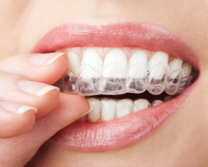Invisalign in Kearny, NJ